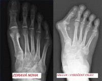 /album/pre-porozumenie-vid-foto1/rtg-halux-jpg2/